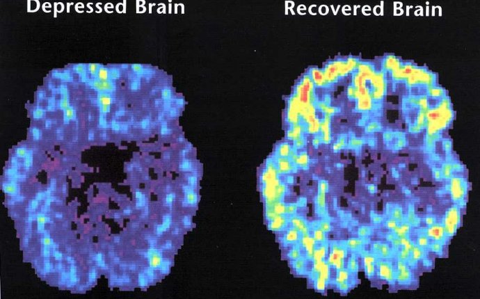 Bipolar Disorder - SCTC ENG 101 Wiki